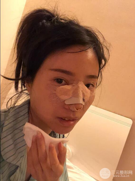 昆明華美美萊楊繼紅肋軟骨隆鼻前后對比圖恢復(fù)手札