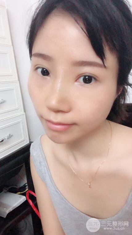 昆明華美美萊楊繼紅肋軟骨隆鼻前后對比圖恢復(fù)手札