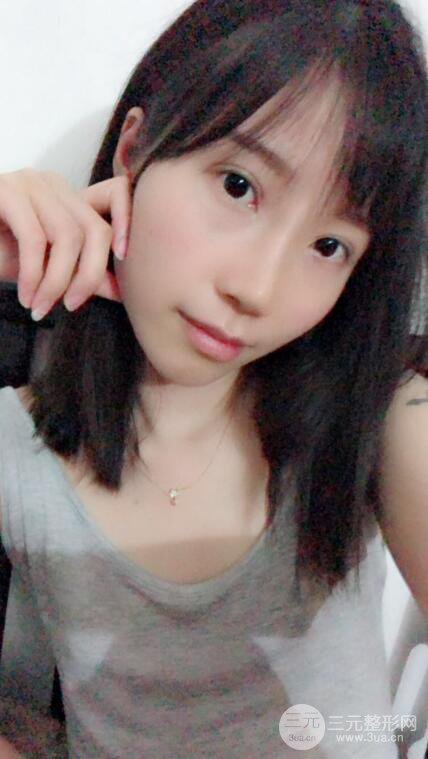 昆明華美美萊楊繼紅肋軟骨隆鼻前后對比圖恢復(fù)手札