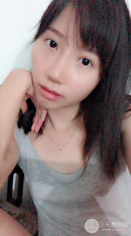 昆明華美美萊楊繼紅肋軟骨隆鼻前后對比圖恢復(fù)手札