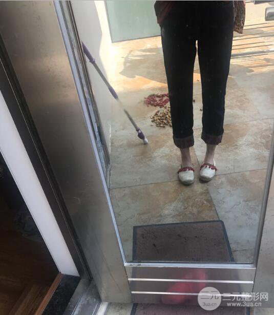 德陽(yáng)東美奧克拉楊華博大腿吸脂前對(duì)對(duì)比圖 四個(gè)月恢復(fù)變化小記