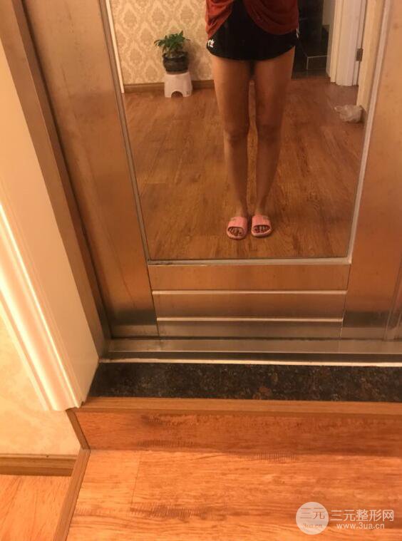 德陽(yáng)東美奧克拉楊華博大腿吸脂前對(duì)對(duì)比圖 四個(gè)月恢復(fù)變化小記