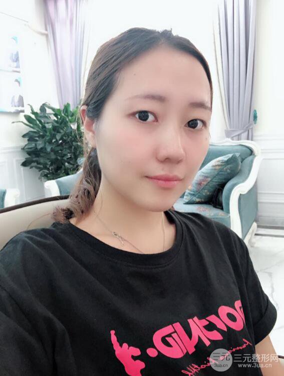 哈醫(yī)大二院整形科肖志波全切雙眼皮前后對比圖 真實恢復(fù)經(jīng)歷日記