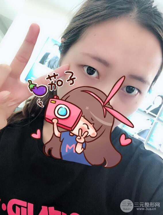 哈醫(yī)大二院整形科肖志波全切雙眼皮前后對比圖 真實恢復(fù)經(jīng)歷日記