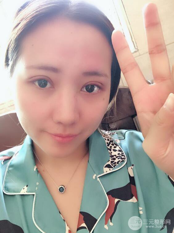 哈醫(yī)大二院整形科肖志波全切雙眼皮前后對比圖 真實恢復(fù)經(jīng)歷日記