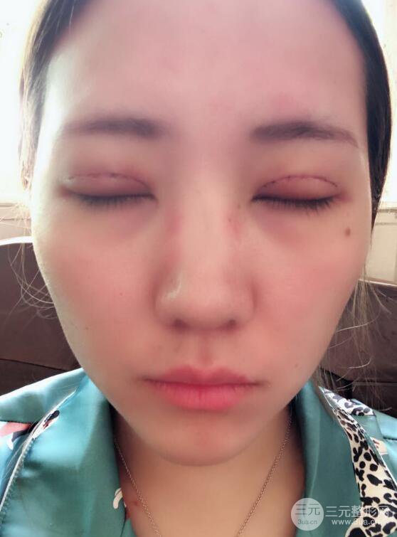 哈醫(yī)大二院整形科肖志波全切雙眼皮前后對比圖 真實恢復(fù)經(jīng)歷日記