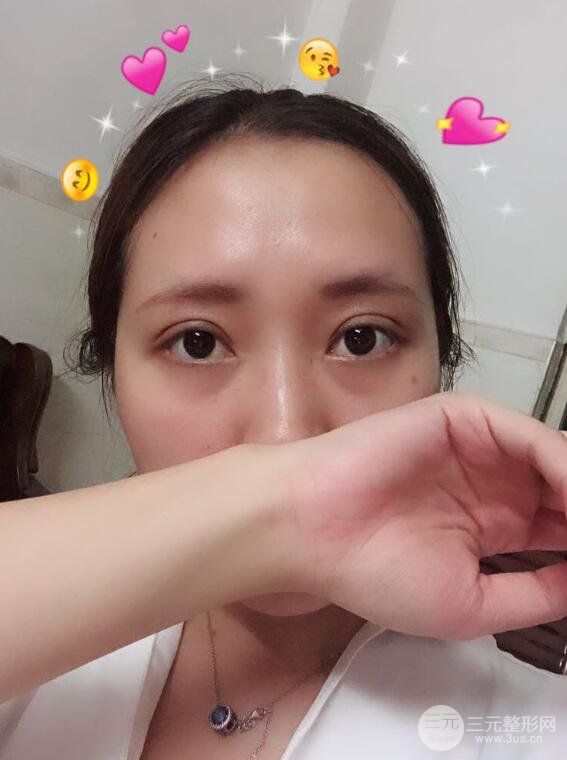 哈醫(yī)大二院整形科肖志波全切雙眼皮前后對比圖 真實恢復(fù)經(jīng)歷日記