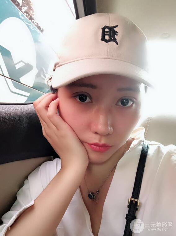 哈醫(yī)大二院整形科肖志波全切雙眼皮前后對比圖 真實恢復(fù)經(jīng)歷日記