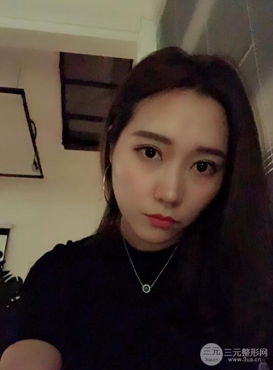 哈醫(yī)大二院整形科肖志波全切雙眼皮前后對比圖 真實恢復(fù)經(jīng)歷日記