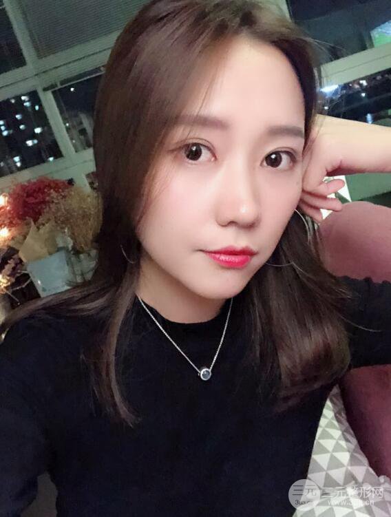 哈醫(yī)大二院整形科肖志波全切雙眼皮前后對比圖 真實恢復(fù)經(jīng)歷日記