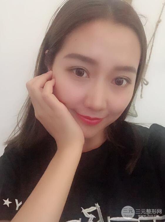 哈醫(yī)大二院整形科肖志波全切雙眼皮前后對比圖 真實恢復(fù)經(jīng)歷日記