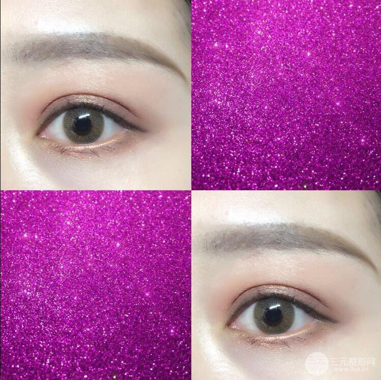 哈醫(yī)大二院整形科肖志波全切雙眼皮前后對比圖 真實恢復(fù)經(jīng)歷日記