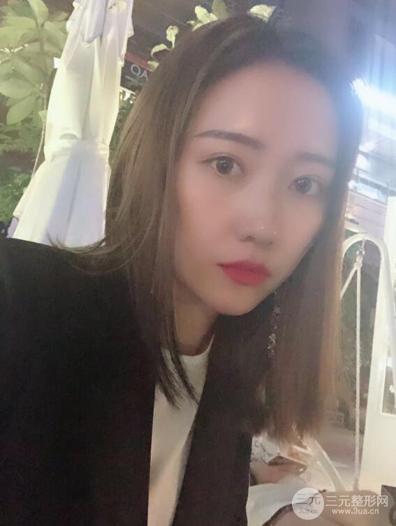 哈醫(yī)大二院整形科肖志波全切雙眼皮前后對比圖 真實恢復(fù)經(jīng)歷日記