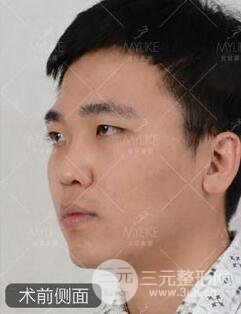 歐陽(yáng)春雙眼皮前后對(duì)比圖 男孩子割雙眼皮一樣好看