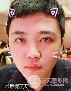 歐陽(yáng)春雙眼皮前后對(duì)比圖 男孩子割雙眼皮一樣好看