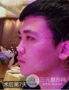 歐陽(yáng)春雙眼皮前后對(duì)比圖 男孩子割雙眼皮一樣好看