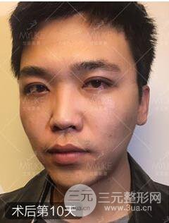 歐陽(yáng)春雙眼皮前后對(duì)比圖 男孩子割雙眼皮一樣好看