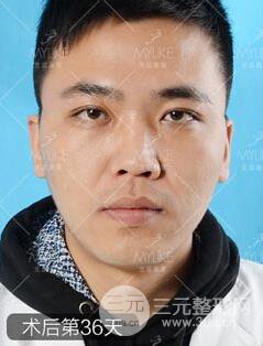 歐陽(yáng)春雙眼皮前后對(duì)比圖 男孩子割雙眼皮一樣好看