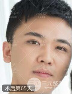 歐陽(yáng)春雙眼皮前后對(duì)比圖 男孩子割雙眼皮一樣好看