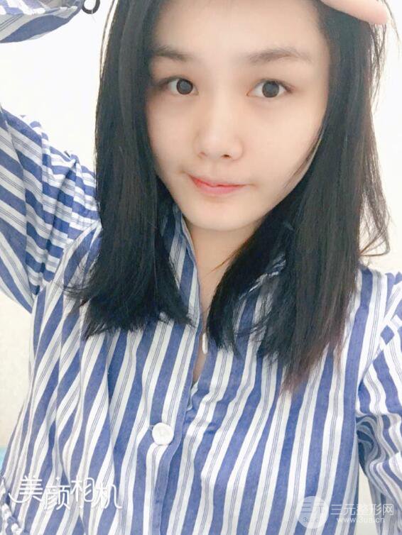 上海薇琳顧陸健韓式隆鼻前后對比圖|真人案例心情日記