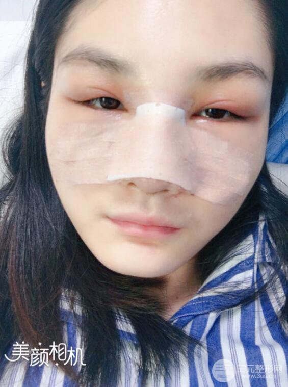 上海薇琳顧陸健韓式隆鼻前后對比圖|真人案例心情日記