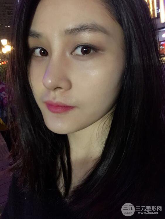 上海薇琳顧陸健韓式隆鼻前后對比圖|真人案例心情日記