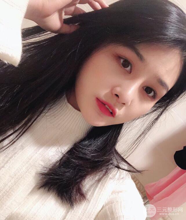 上海薇琳顧陸健韓式隆鼻前后對比圖|真人案例心情日記