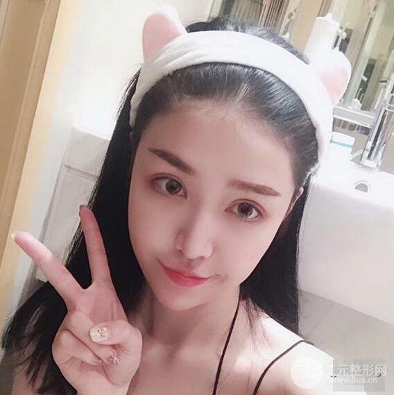 延吉金光善眼部整形失敗修復(fù)前后對比圖 三個月恢復(fù)自然