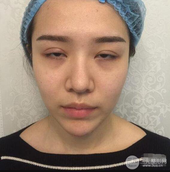 延吉金光善眼部整形失敗修復(fù)前后對比圖 三個月恢復(fù)自然