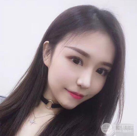 延吉金光善眼部整形失敗修復(fù)前后對比圖 三個月恢復(fù)自然