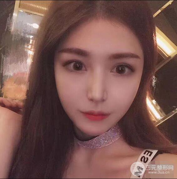 延吉金光善眼部整形失敗修復(fù)前后對比圖 三個月恢復(fù)自然