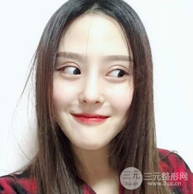 北京美萊趙峻賢隆鼻整形真實案例對比圖恢復(fù)過程分享