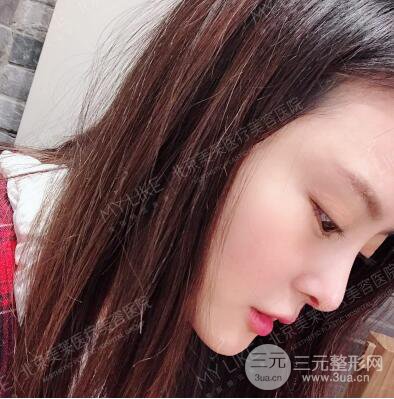 北京美萊趙峻賢隆鼻整形真實案例對比圖恢復(fù)過程分享