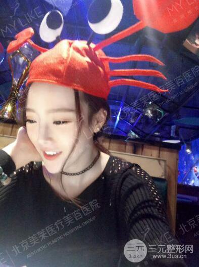 北京美萊趙峻賢隆鼻整形真實案例對比圖恢復(fù)過程分享