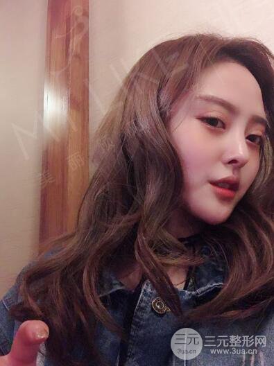 北京美萊趙峻賢隆鼻整形真實案例對比圖恢復(fù)過程分享