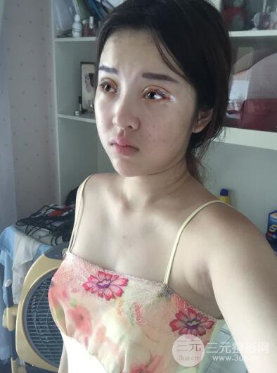 成都天使之翼張勁松切開雙眼皮案例前后對比圖心情小札