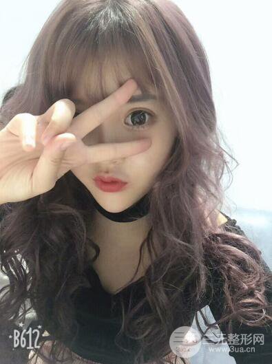 成都天使之翼張勁松切開雙眼皮案例前后對比圖心情小札