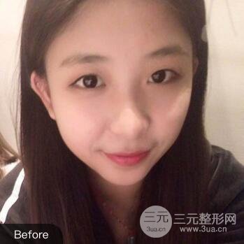 沈陽(yáng)軍區(qū)總醫(yī)院時(shí)杰切開(kāi)雙眼皮案例對(duì)比圖|內(nèi)附心情恢復(fù)小札哦