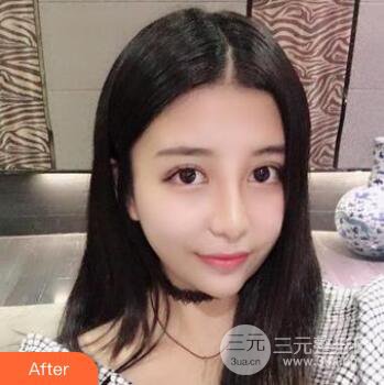 沈陽(yáng)軍區(qū)總醫(yī)院時(shí)杰切開(kāi)雙眼皮案例對(duì)比圖|內(nèi)附心情恢復(fù)小札哦