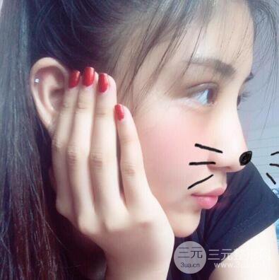 沈陽(yáng)軍區(qū)總醫(yī)院時(shí)杰切開(kāi)雙眼皮案例對(duì)比圖|內(nèi)附心情恢復(fù)小札哦