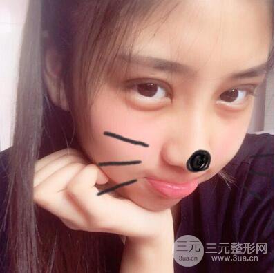 沈陽(yáng)軍區(qū)總醫(yī)院時(shí)杰切開(kāi)雙眼皮案例對(duì)比圖|內(nèi)附心情恢復(fù)小札哦