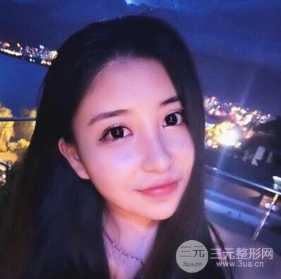 沈陽(yáng)軍區(qū)總醫(yī)院時(shí)杰切開(kāi)雙眼皮案例對(duì)比圖|內(nèi)附心情恢復(fù)小札哦