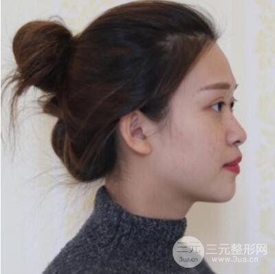 哈爾濱哈美萊鄭東學隆鼻整形案例對比圖真實心情分享喲~