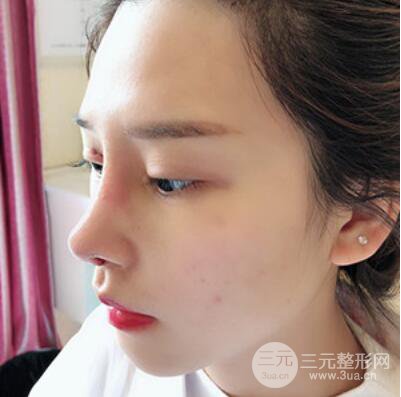 哈爾濱哈美萊鄭東學隆鼻整形案例對比圖真實心情分享喲~