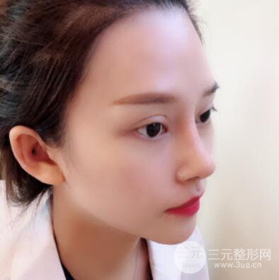 哈爾濱哈美萊鄭東學隆鼻整形案例對比圖真實心情分享喲~