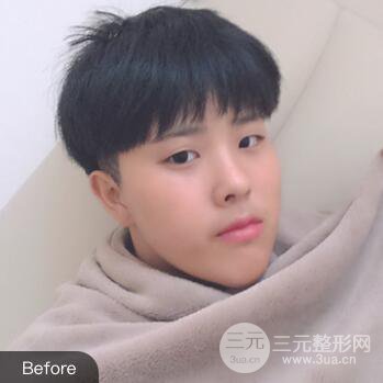 哈醫(yī)大二院整形科肖志波割雙眼皮對(duì)比圖男性案例