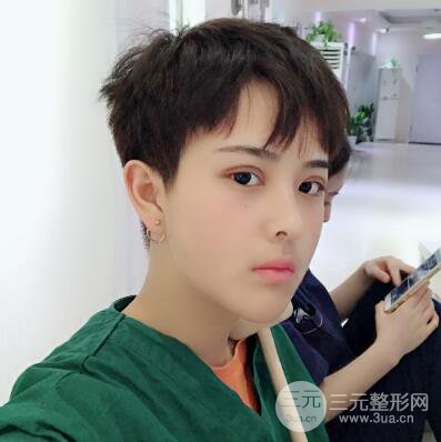 哈醫(yī)大二院整形科肖志波割雙眼皮對(duì)比圖男性案例