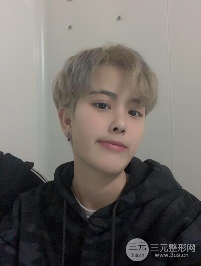 哈醫(yī)大二院整形科肖志波割雙眼皮對(duì)比圖男性案例