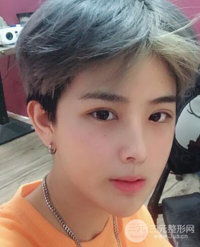 哈醫(yī)大二院整形科肖志波割雙眼皮對(duì)比圖男性案例