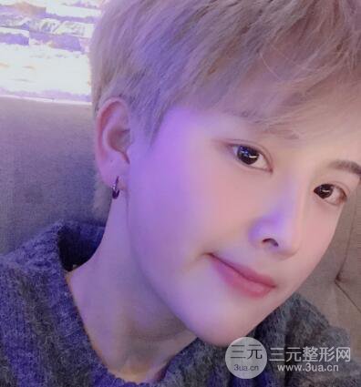 哈醫(yī)大二院整形科肖志波割雙眼皮對(duì)比圖男性案例